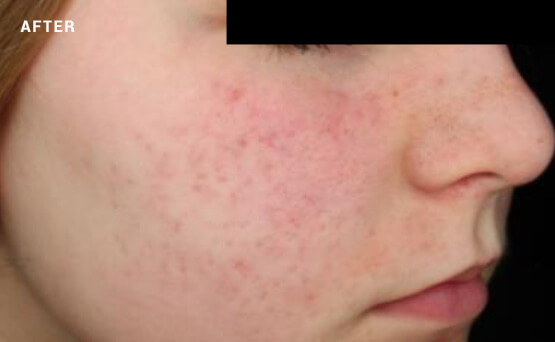 Acne scars on face after laser treatment
