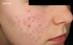 Acne scars on face before laser treatment