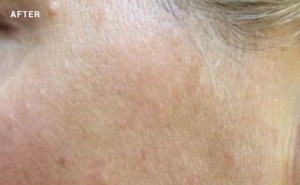 Dark spot on skin after laser treatment