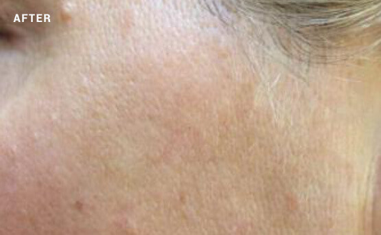 Dark spot on skin after laser treatment