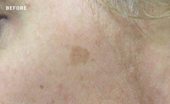 Dark spot on skin before laser treatment