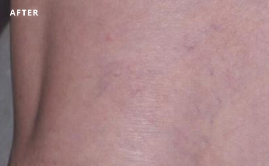 Leg veins after laser treatment