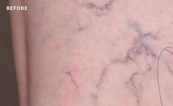 Leg veins before laser treatment