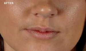 Face after microdermabrasion treatment