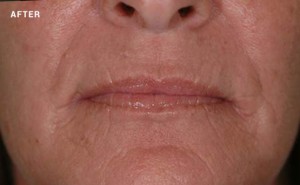 Woman wrinkles disappear after laser skin tightening