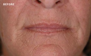 Woman wrinkles before laser skin tightening