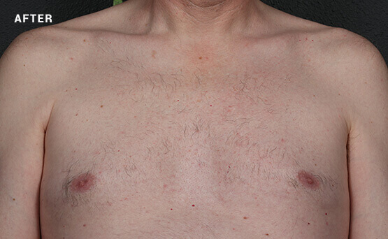 Man's hair chest after laser hair removal treatment