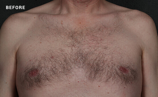 Man's hair chest before laser hair removal treatment