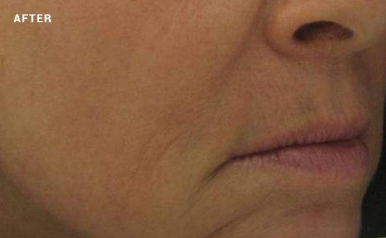 Woman's skin after non-surgical facelift