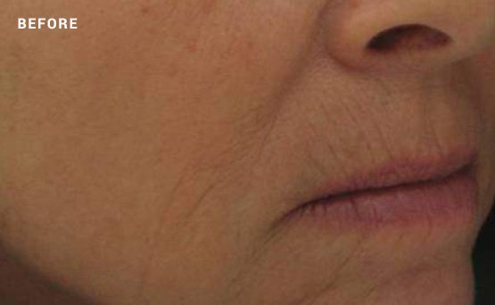 Woman's skin before non-surgical facelift