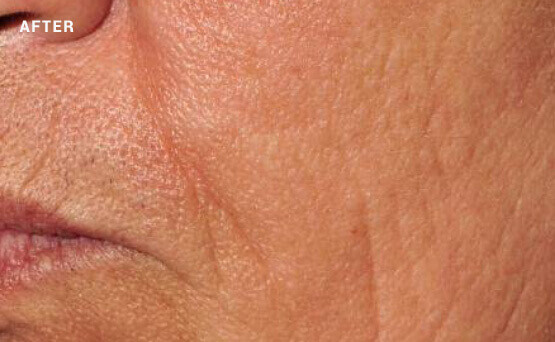 Woman's skin after laser skin rejuvenation treatment