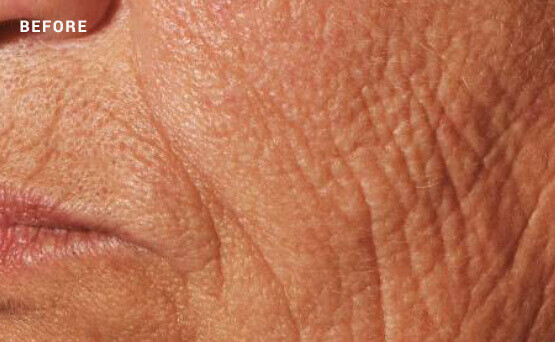 Woman's skin before laser skin rejuvenation treatment