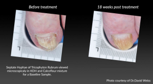 Before and After toenail fungus