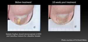 Before and After Toenail Fungus