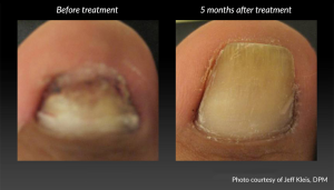 Before and After Toenail Fungus