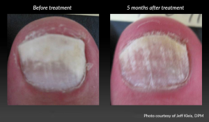 Before and After Toenail Fungus