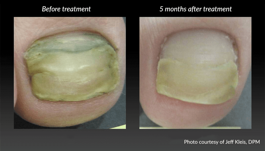 Before and After Toenail Fungus