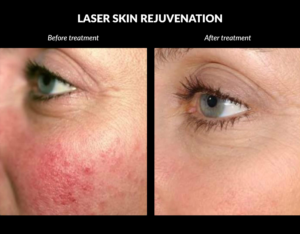 Laser Skin Rejuvenation Before and After