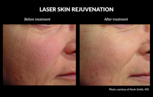 Laser Skin Rejuvenation Before and After