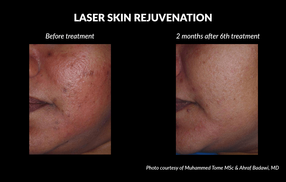 Laser Skin Rejuvenation Before and After