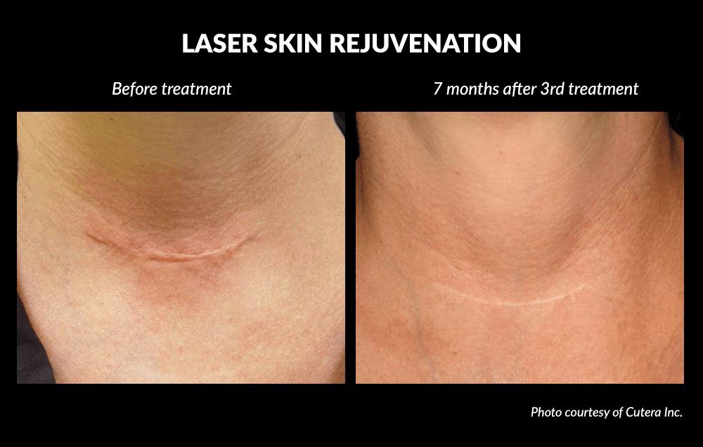 Laser Skin Rejuvenation Before and After