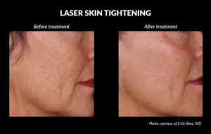 Laser Skin Tightening Before and After