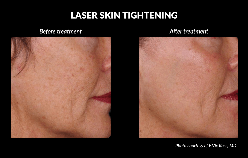 Laser Skin Tightening Before and After
