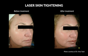 Laser Skin Tightening Before and After