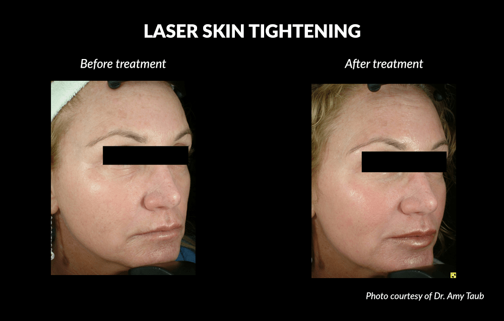 Laser Skin Tightening Before and After