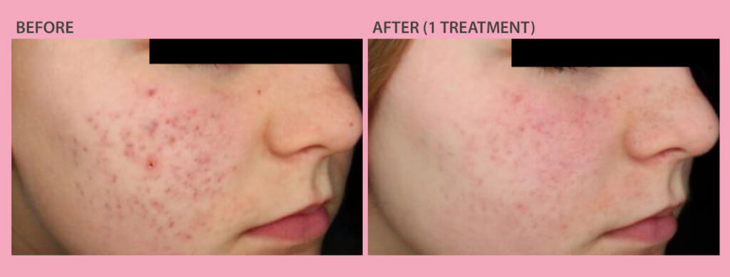 Before and After Laser Acne Scars