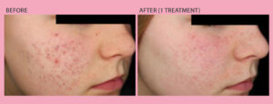 Before and After Laser Acne Scars