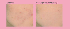 Before & After Laser Acne Scars