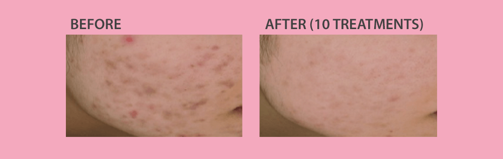 Before & After Laser Acne Scars