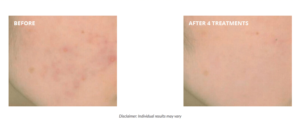 Shrink large pores laser genesis vancouver