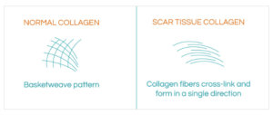 types of acne scars