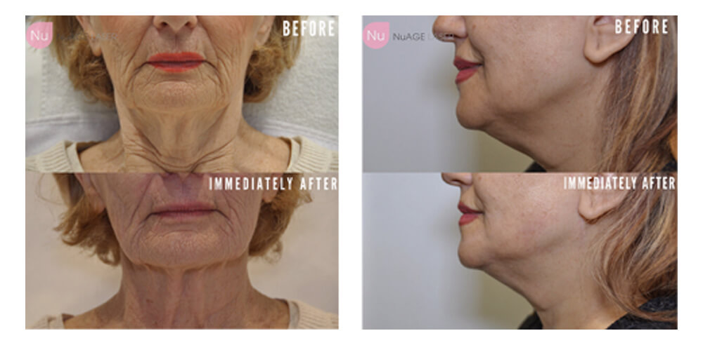 skin-tightening-laser-vancouver-nuage