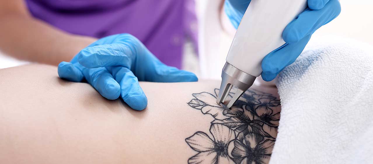 Goodbye Tattoo Regrets: Removing Tattoos Without Lasers