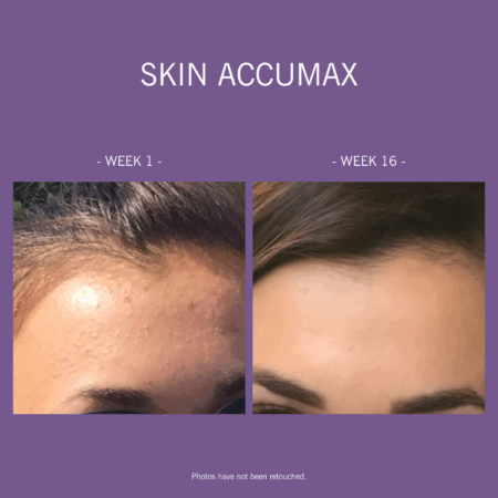 Skin Accumax - Image 9