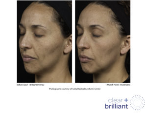 before and after photo of clear + brilliant treatment