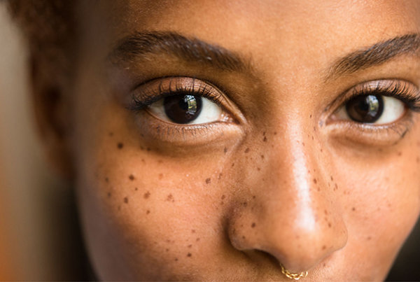 girl with melasma skin