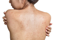 girl with back acne