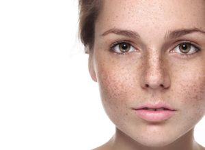 girl's face with freckles