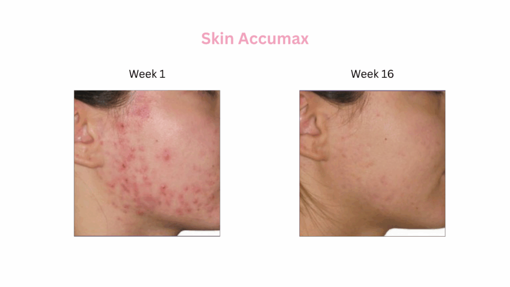 Skin Accumax
