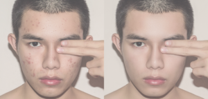 Acne awareness month