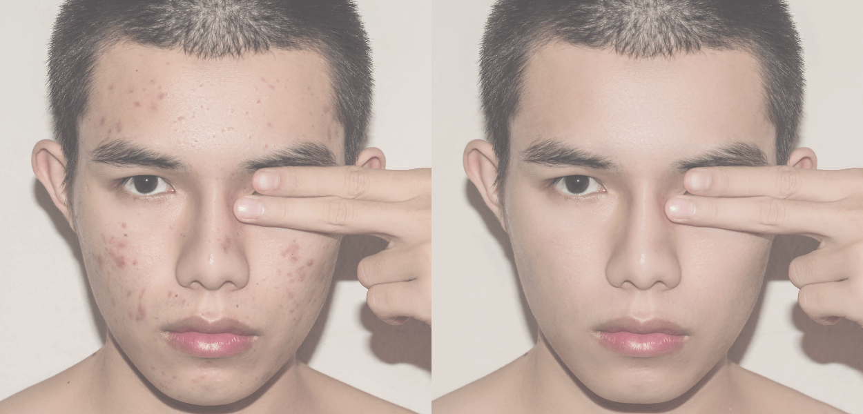Acne Awareness Month: A Holistic Approach to Clearer, Healthier Skin