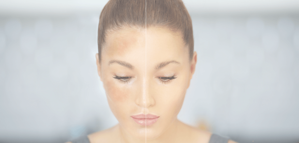 Melasma Awareness Month: Understanding and Treating Stubborn Pigmentation